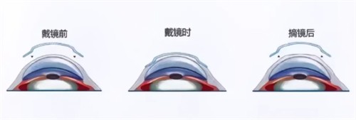 角膜塑形镜佩戴 角膜塑形镜佩戴