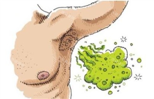 广元除腋臭医院哪家好？这五家医院技术对比，价格透明，让你轻松摆脱腋臭困扰！