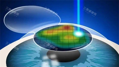 个性化微飞秒手术过程图片 个性化微飞秒手术过程图片