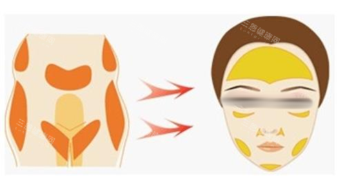 自体脂肪面部填充示意图