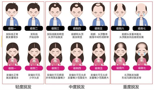 不同程度的脂溢性脱发 不同程度的脂溢性脱发