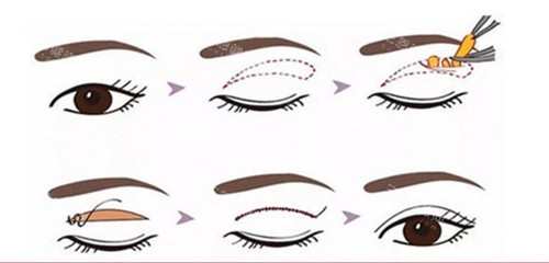 全切双眼皮过程示意图 全切双眼皮过程示意图