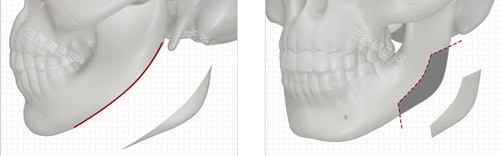 下颌角手术 下颌角手术