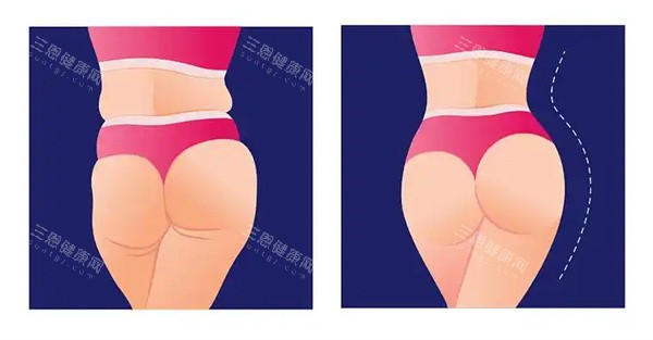 臀部脂肪填充 臀部脂肪填充