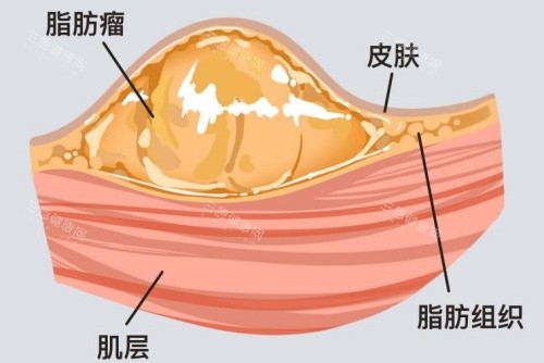 脂肪瘤所在皮肤层面示意图 脂肪瘤所在皮肤层面示意图