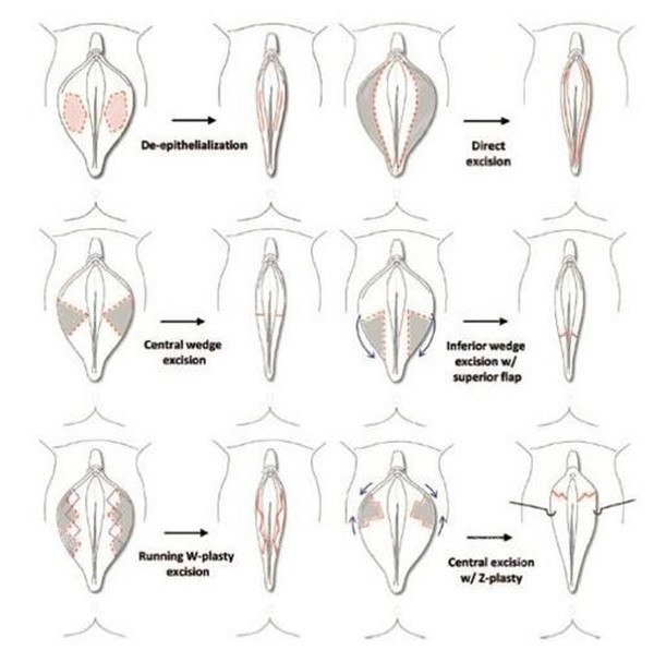 私密阴唇手术方法照片 私密阴唇手术方法照片