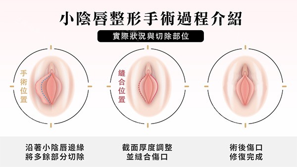 阴唇一边长一边短改善照片 阴唇一边长一边短改善照片