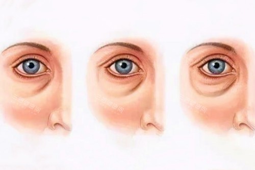 眼袋加深卡通图 眼袋加深卡通图