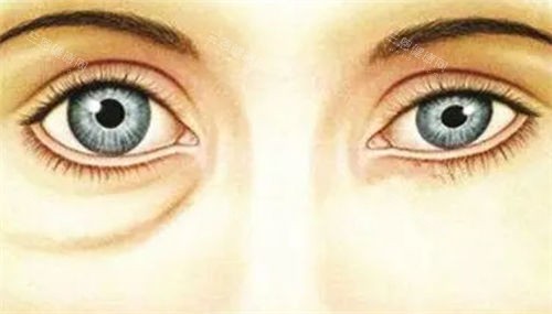 假性眼袋对比展示图 假性眼袋对比展示图