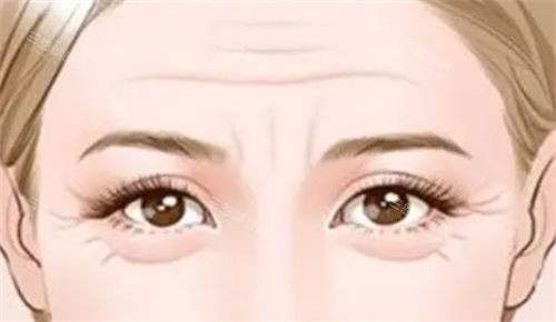 泪沟型眼袋和眼角细纹展示图 泪沟型眼袋和眼角细纹展示图