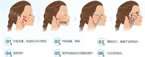 微拉美拉皮手术过程图 微拉美拉皮手术过程图