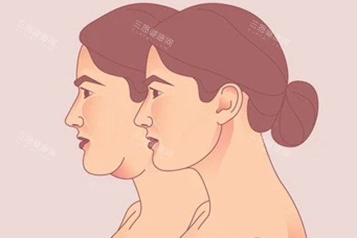 颈部拉皮变成天鹅颈 颈部拉皮变成天鹅颈