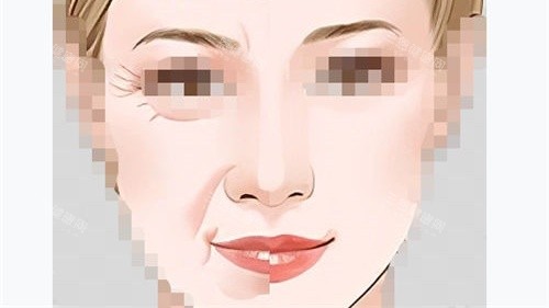 拉皮手术前后对比示意图.jpg 拉皮手术前后对比示意图.jpg