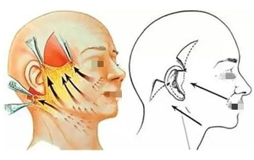 韩国拉皮手术价格大公开！大拉皮vs小切口差价多少？这份价格表帮你省下冤枉钱！