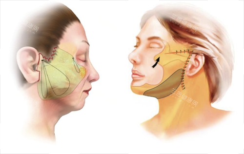 拉皮手术面部脂肪组织区域圈画图 拉皮手术面部脂肪组织区域圈画图