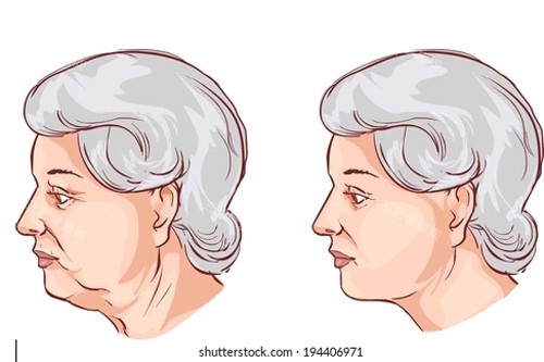 颈部拉皮卡通图 颈部拉皮卡通图