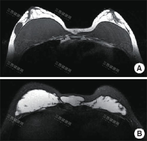 不明注射物在胸部中的样子 不明注射物在胸部中的样子