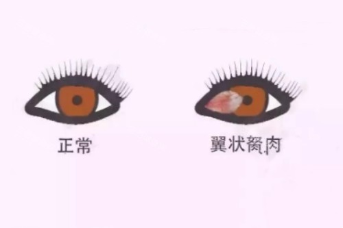 翼状胬肉与正常眼睛对比