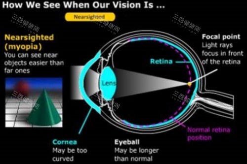 近视眼球结构 近视眼球结构