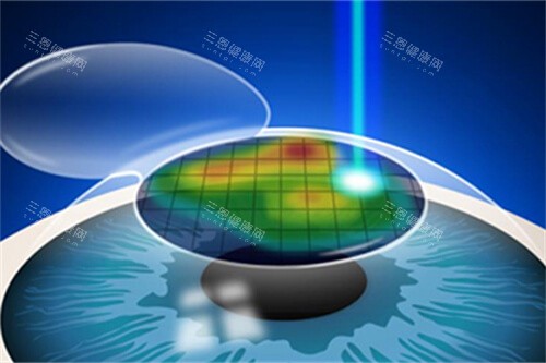 近视手术漫画示意图 近视手术漫画示意图