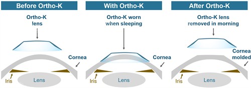 OK镜改善眼睛角膜的弧度