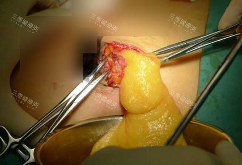 奥美定取出手术细节图 奥美定取出手术细节图