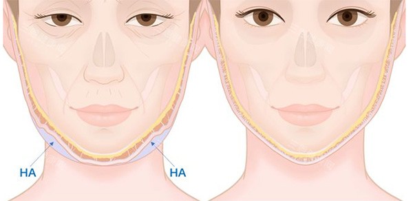 馒化脸改善前后变化 馒化脸改善前后变化