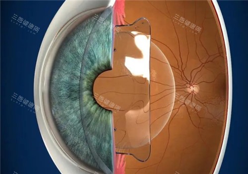 晶体植入近视手术模拟图 晶体植入近视手术模拟图