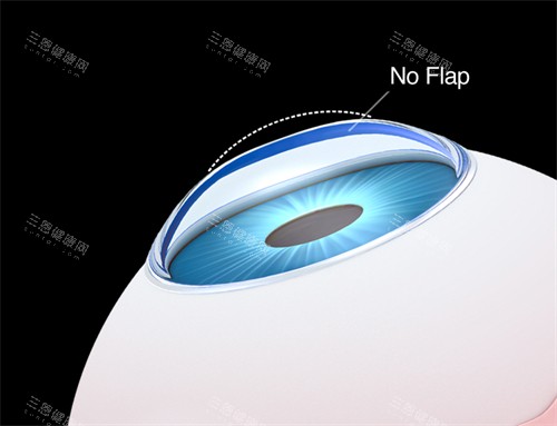 smart激光近视手术示意图 smart激光近视手术示意图