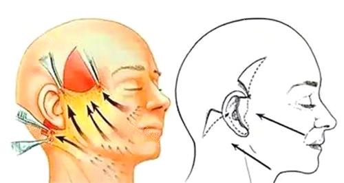 拉皮手术图 拉皮手术图