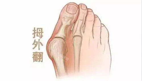 大脚骨示意图 大脚骨示意图