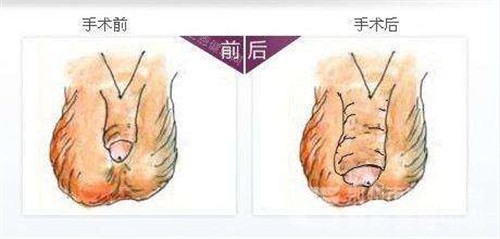 阴茎增粗手术前后对比图 阴茎增粗手术前后对比图