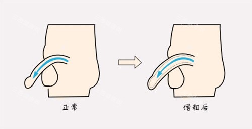 增粗术前后对比 增粗术前后对比