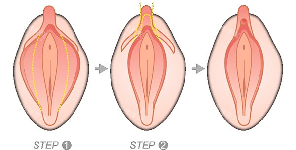 大阴唇手术怎么做 大阴唇手术怎么做