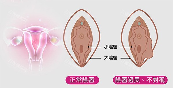 阴唇不对称改善照片 阴唇不对称改善照片