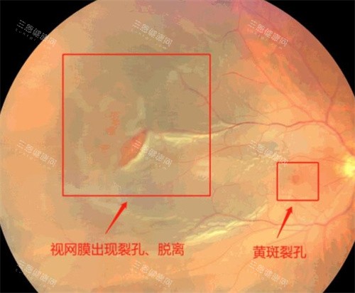 人工视网膜2030进入临床吗？欧洲17中心试验达标，国内2025启动人体试验，芯片5年换电技术成熟！