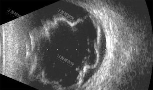 孔源性视网膜脱离扫描细节 孔源性视网膜脱离扫描细节
