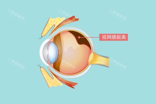 视网膜脱落图片展示 视网膜脱落图片展示