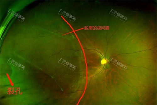 孔源性视网膜脱离的图 孔源性视网膜脱离的图