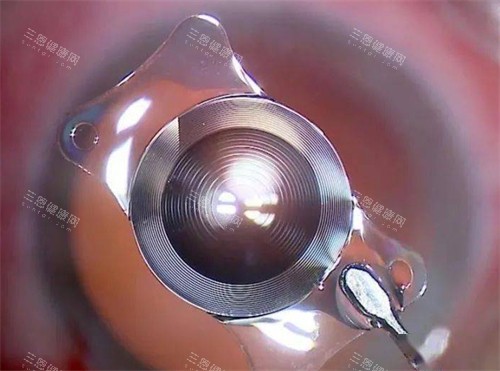 白内障晶体展示 白内障晶体展示