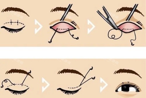 大连刘志刚双眼皮做的怎样？凭借20多年临床经验、娴熟的技术、自然审美的风格，备受认可！