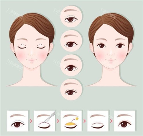 切开双眼皮手术前后对比和过程 切开双眼皮手术前后对比和过程