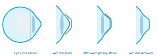 角膜塑形镜可以改善眼表曲度 角膜塑形镜可以改善眼表曲度