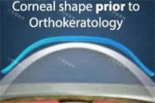 角膜塑形镜4 角膜塑形镜4