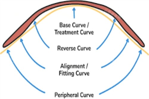 角膜塑形镜作用示意图 角膜塑形镜作用示意图