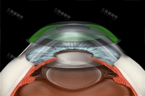 角膜塑形镜原理示意图