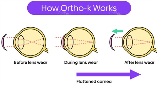 什么是角膜塑形镜 什么是角膜塑形镜