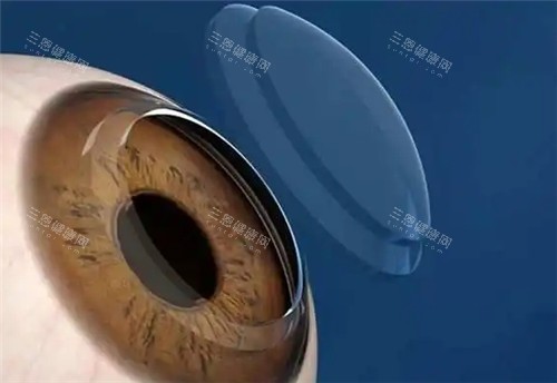 角膜塑形镜佩戴图 角膜塑形镜佩戴图