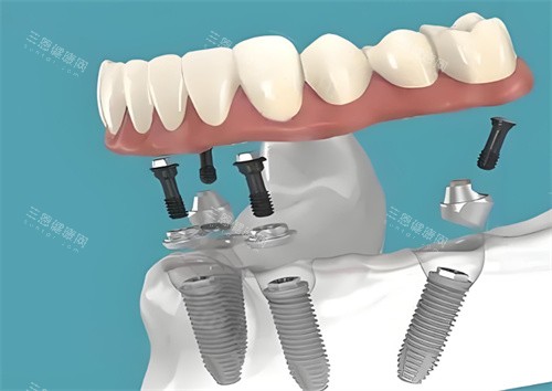 种植牙图片展示图 种植牙图片展示图
