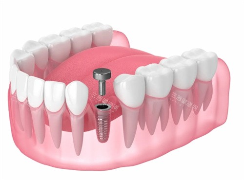 种植牙基台安装透视动画 种植牙基台安装透视动画